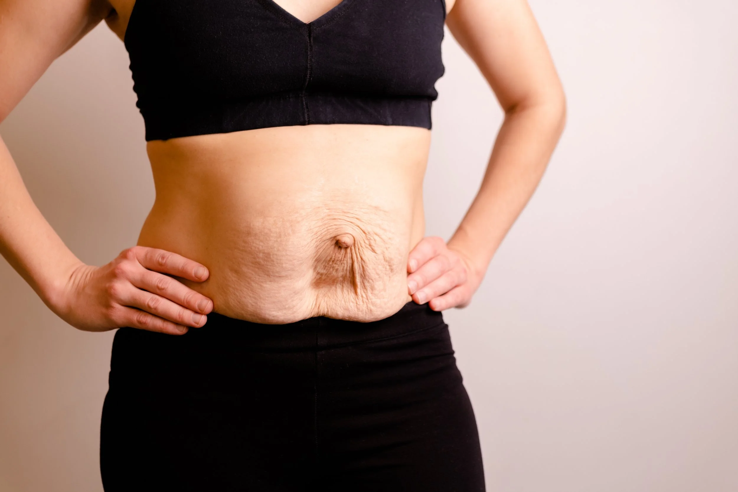 Visible diastasis recti in postpartum abdomen